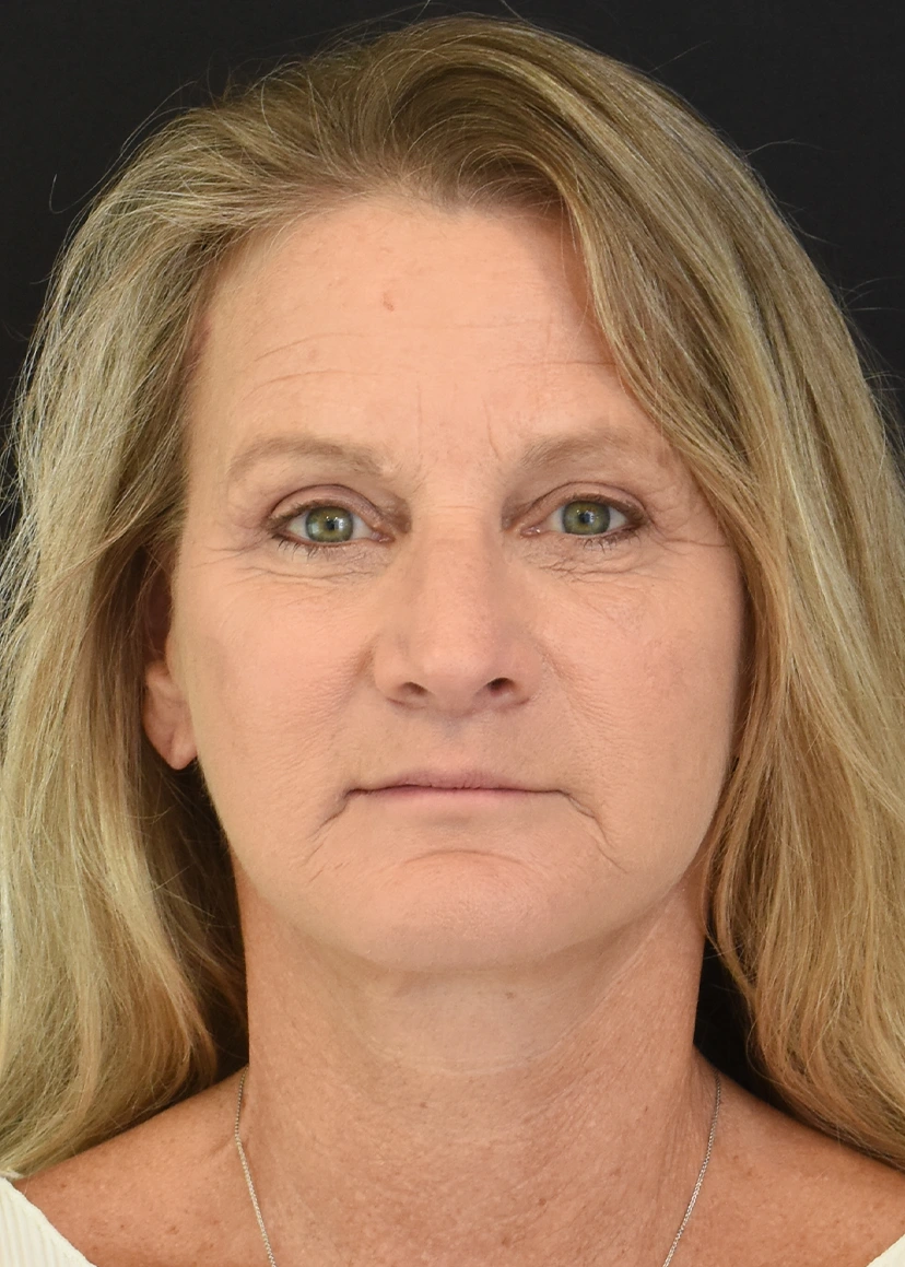 Deep Plane Facelift Patient 34 Set 3 After