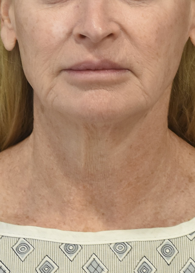Deep Plane Facelift Patient 42 Set 1 Before