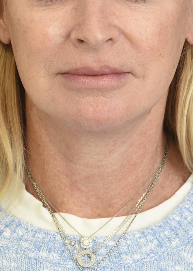 Deep Plane Facelift Patient 42 Set 1 After